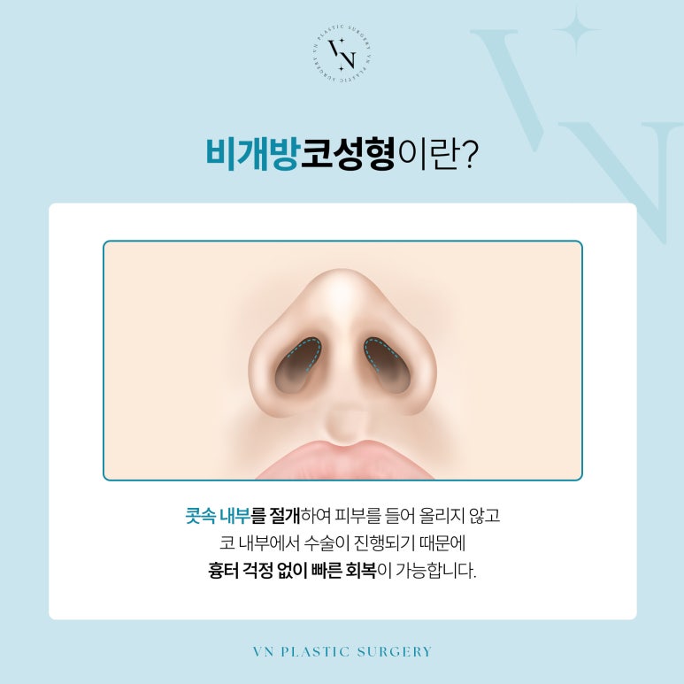 What Are the Differences Between Non-Open and Open Rhinoplasty? image 2