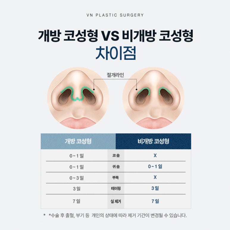 브이엔성형외과 비개방 코재수술, 꼭 알아야 할 정보✨ 관련 이미지 2