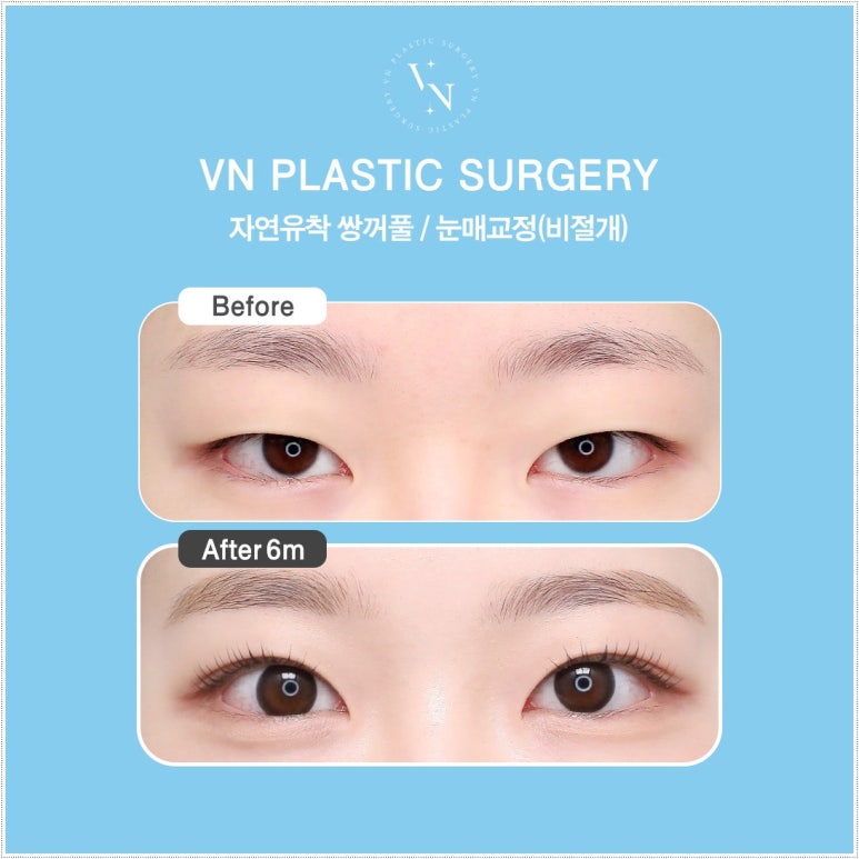 How Eyelid Correction Changes the Eyes: Comparison of Incision and Non-Incision Methods and Recovery Time image 8