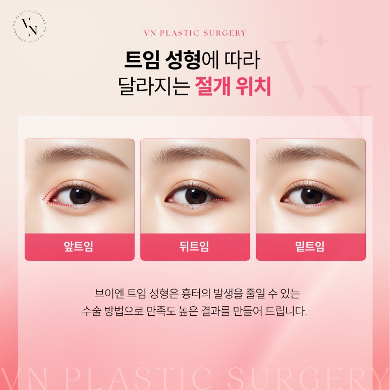 트임 흉터가 걱정된다면 흉터 최소화 트임 수술의 원리 관련 이미지 2