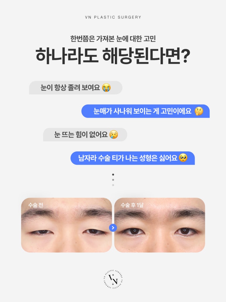 수험생도 부담 없이, 신논현성형외과 티 안 나는 남자눈성형 관련 이미지 3