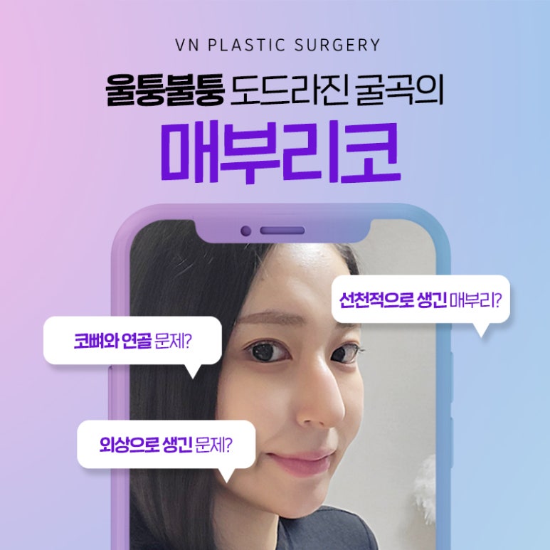 브이엔성형외과 제공｜매부리코교정 방법은? 관련 이미지 2