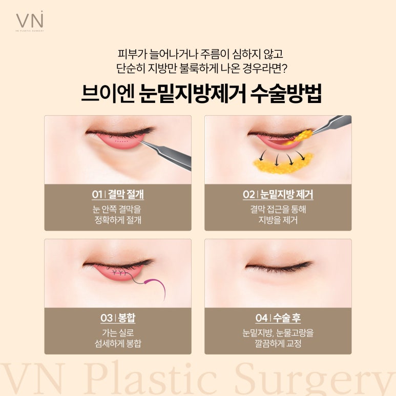 눈밑지방재배치, 노안에서 동안으로 관련 이미지 4
