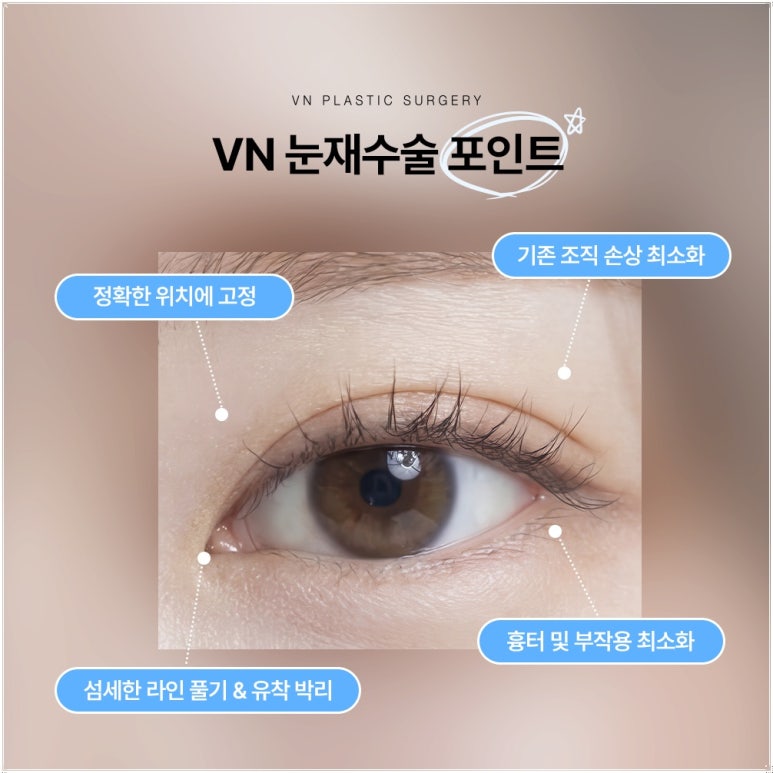 강남눈재수술, 원인이 다르면 방법도 달라집니다 관련 이미지 5