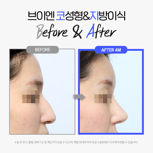 VN Plastic Surgery Coeima Fat Grafting That Determines a Refined Impression image 8