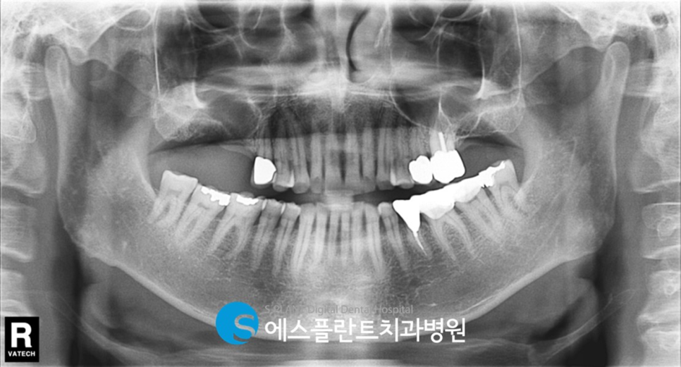 고난이도 상악동 거상술 임플란트 잘하는 치과, 에스플란트 치과병원 관련 이미지 3