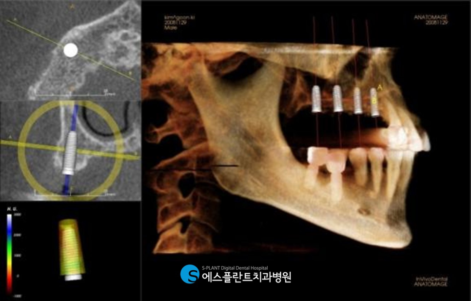 저작기능의 핵심, 어금니 임플란트 식립에는 압구정 에스플란트 치과병원의 가이드 임플란트 관련 이미지 5