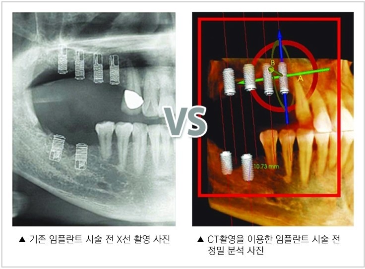 [뼈이식임플란트통증] 강남임플란트, 잇몸 뼈 이식을 꼭 해야하나요? 관련 이미지 2