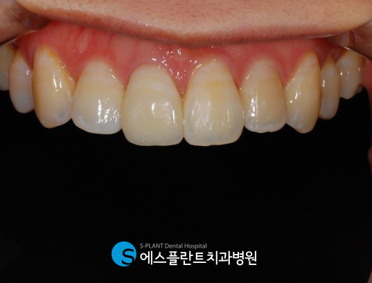 A case of regaining confidence with immediate implant placement after front tooth extraction at Esplant Dental Hospital, a dental clinic near Apgujeong Rodeo Station known for implants image 6