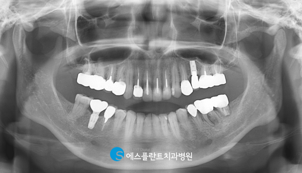 강남 압구정로데오 임플란트 잘하는 치과 에스플란트치과의 골이식을 동반한 어금니 발치 후 즉시 식립 임플란트 (아스트라 임플란트) 관련 이미지 2
