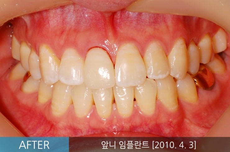 [앞니임플란트기간] 앞니임플란트, 당일 발치 후 즉시 식립 임플란트 CASE 관련 이미지 2