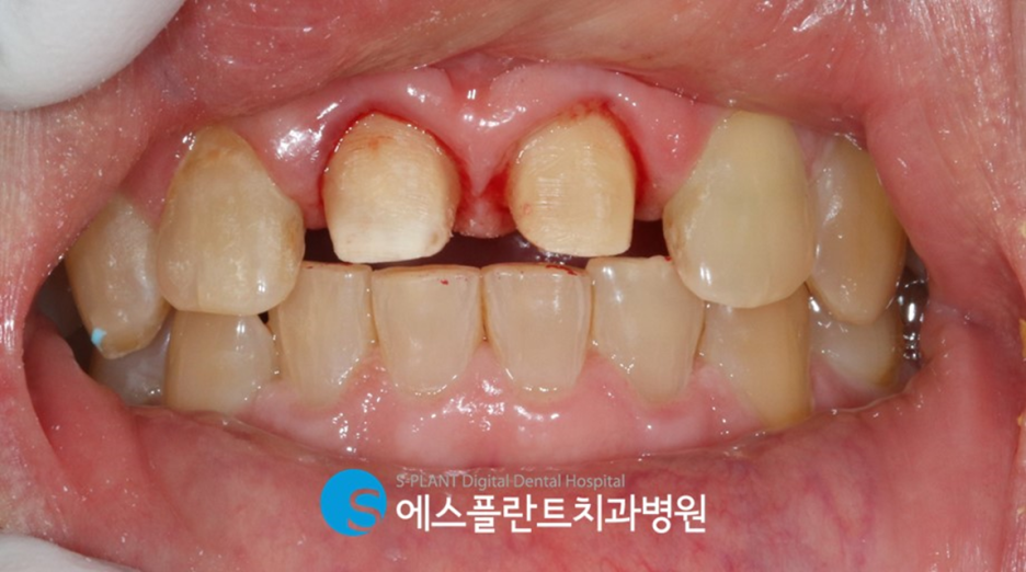 자연스러운 앞니 보철을 원한다면?! 압구정 앞니보철 잘하는 치과, 에스플란트치과병원에서 관련 이미지 3