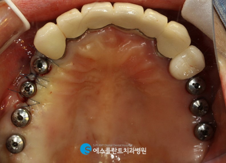 압구정로데오역치과 임플란트 잘하는 치과, 에스플란트 치과병원에서 실제로 사용하는 가이드 임플란트란?! 관련 이미지 8