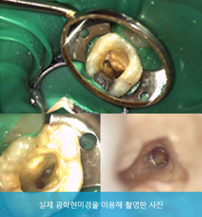 자연치아를 최대한 보존하기 위한 신경치료 [에스플란트 치과병원] 관련 이미지 7