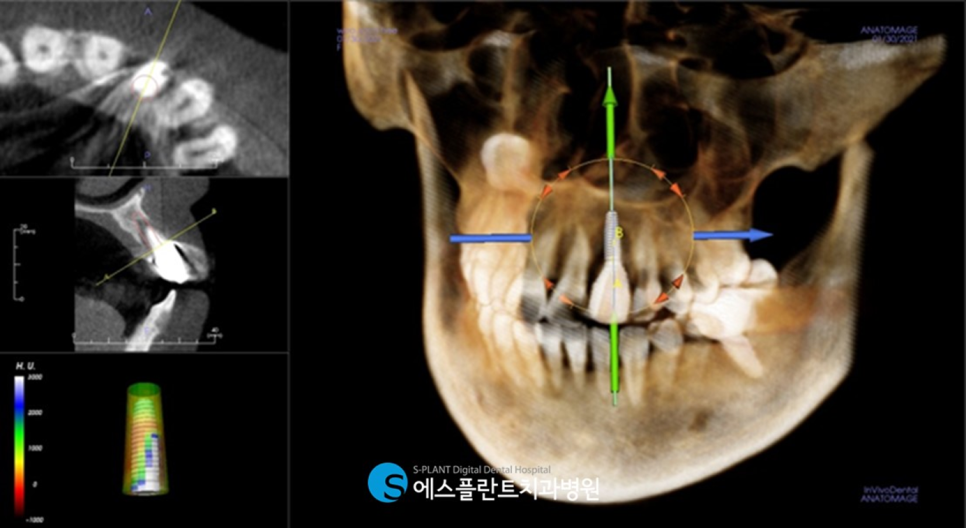 당일 임플란트 원데이 임플란트 수술이 가능한 강남치과, 에스플란트치과병원 관련 이미지 4