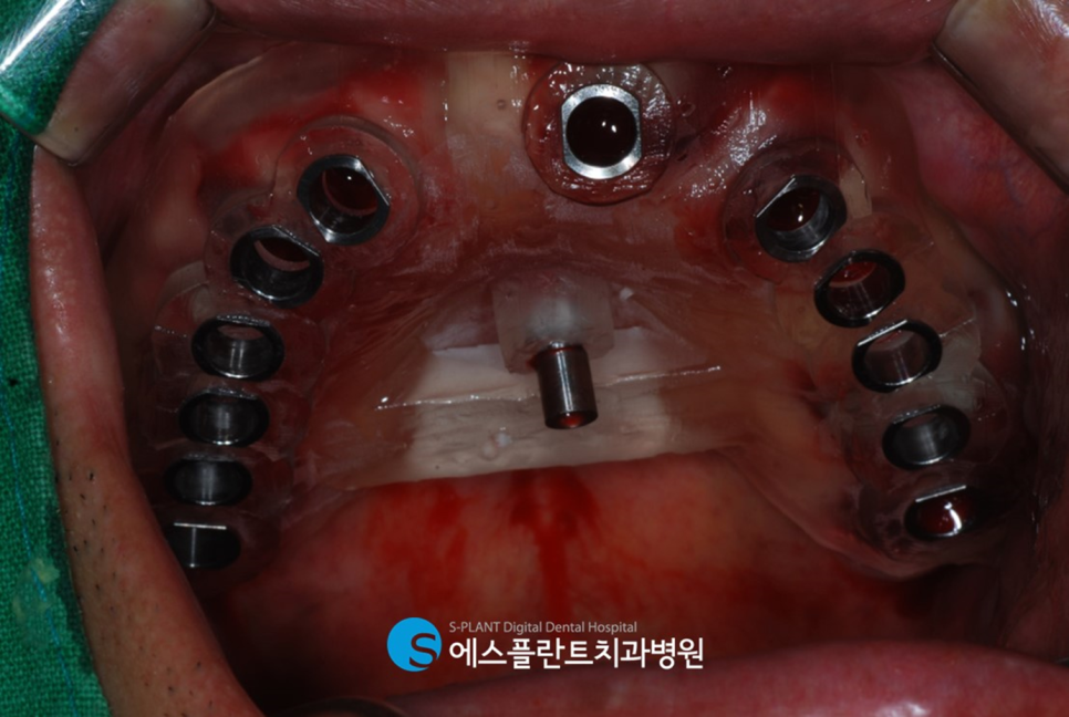 압구정 임플란트, 에스플란트치과병원의 편안하고 정확한 식립이 가능한 전악 가이드 임플란트 관련 이미지 8
