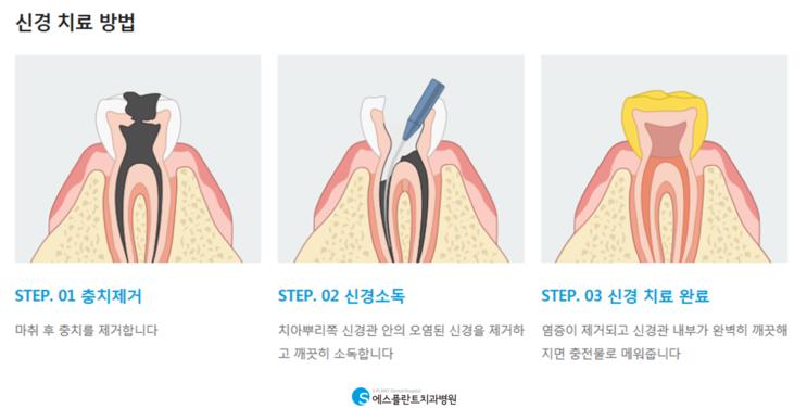 치과에서 신경치료 후 통증해결 방법 관련 이미지 2
