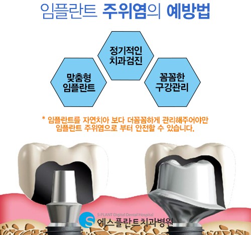 심각하면 재수술까지 이어지는 임플란트 주위염 예방방법은? 관련 이미지 6