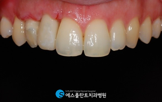 상악 전치부 임플란트로 심미성을 회복하세요. 관련 이미지 6