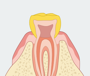 자연치아를 최대한 보존하기 위한 신경치료 [에스플란트 치과병원] 관련 이미지 5