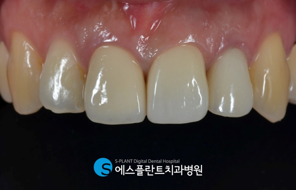압구정로데오역 임플란트치과 에스플란트치과병원의 심미성을 고려한 지르코니아 지대주 앞니 임플란트 관련 이미지 5