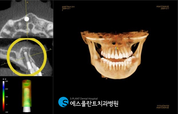 A case of regaining confidence with immediate implant placement after front tooth extraction at Esplant Dental Hospital, a dental clinic near Apgujeong Rodeo Station known for implants image 3