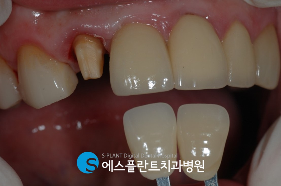 선천적으로 작은 왜소치 압구정로데오역 에스플란트치과 심미보철로 해결 관련 이미지 3