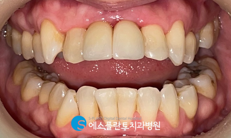 치주염 앞니 잇몸 염증으로 흔들릴 때 압구정 에스플란트치과병원 가이드임플란트 식립으로 관련 이미지 6