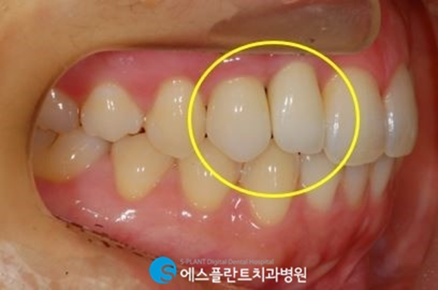 상악 전치부 임플란트로 심미성을 회복하세요. 관련 이미지 7