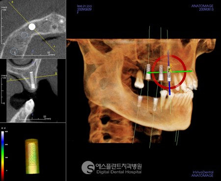 [어금니임플란트치과] 어금니 임플란트 가격, 어금니 임플란트 시술과 정 관련 이미지 4