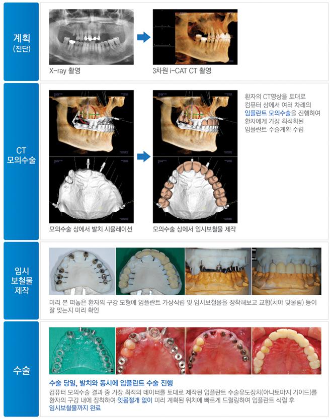 하루에 발치부터 식립까지 가능한 에스플란트치과병원 원데이임플란트 관련 이미지 3