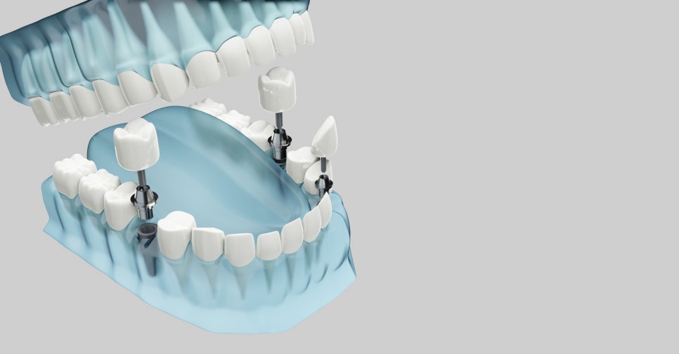 Apgujeong Rodeo Dental Clinic Implants: What Should Be Considered? image 2