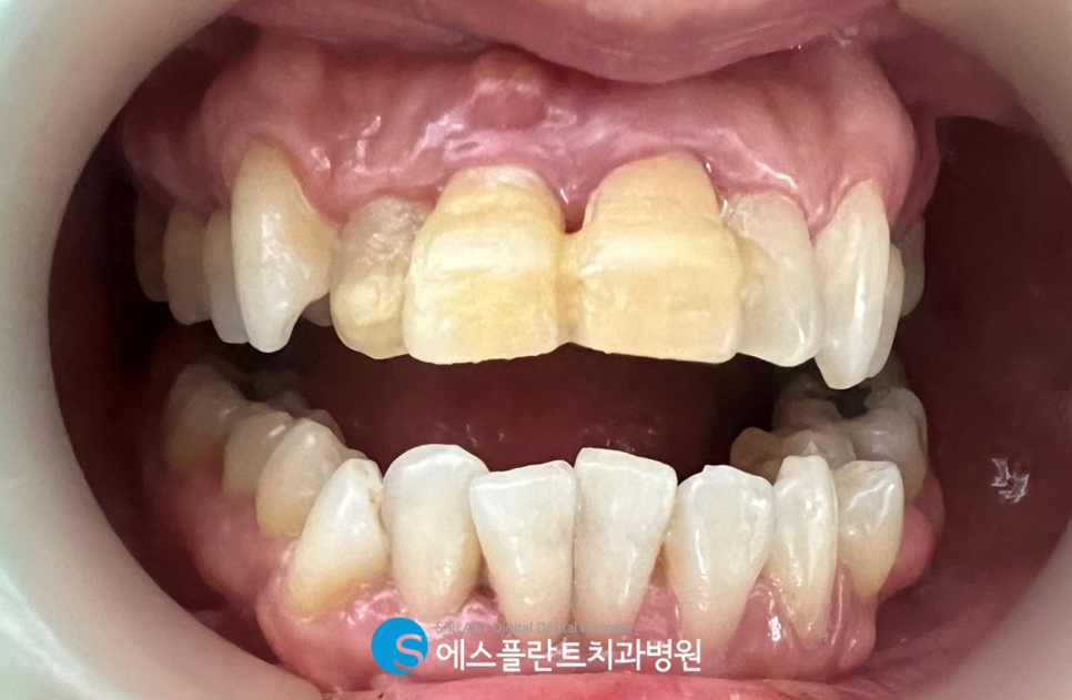 치주염 앞니 잇몸 염증으로 흔들릴 때 압구정 에스플란트치과병원 가이드임플란트 식립으로 관련 이미지 2