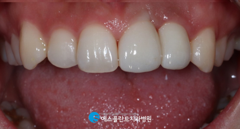 앞니 임플란트 잘하는 강남 치과, 에스플란트치과병원의 만족도 높은 앞니 심미 임플란트 관련 이미지 6