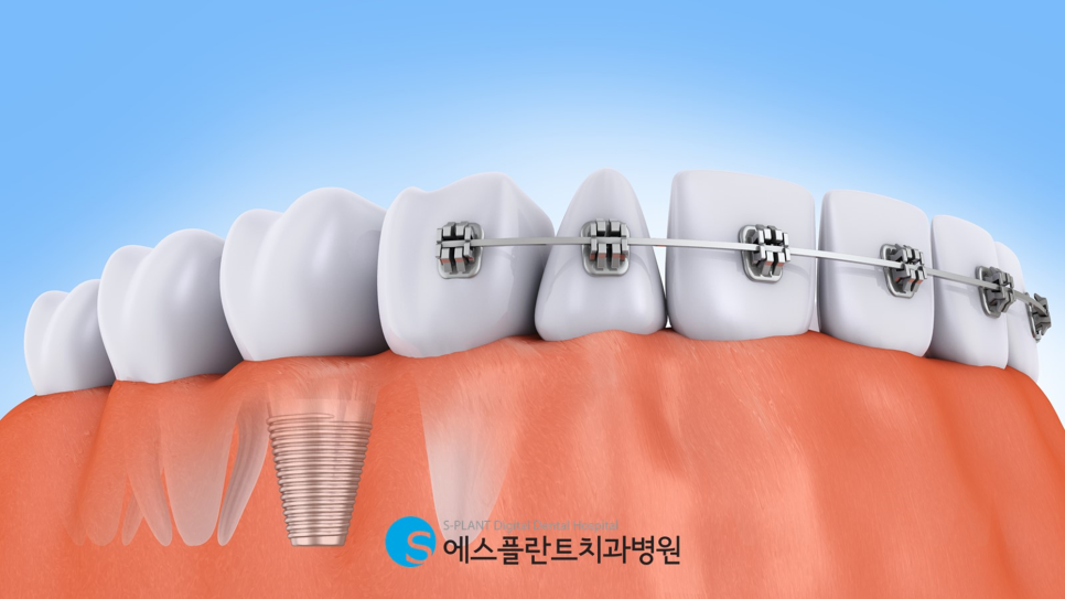 Why Is E-Splant Dental Clinic Recommended for Implant Surgery for People in Their 20s in Apgujeong Rodeo?! image 2
