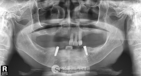 [임플란트후기] 뼈이식 임플란트, 임플란트 틀니 전/후 Story 임플란트 CASE 관련 이미지 5