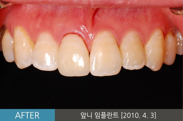 [앞니임플란트기간] 앞니임플란트, 당일 발치 후 즉시 식립 임플란트 CASE 관련 이미지 4