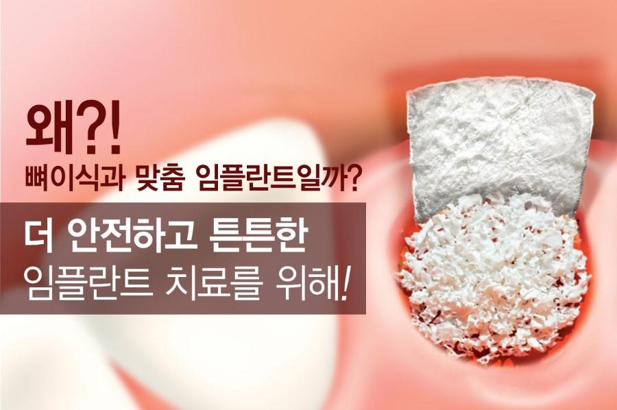 더튼튼한임플란트치료를원한다면에스플란트치과병원에문의하세 요. 관련 이미지 2