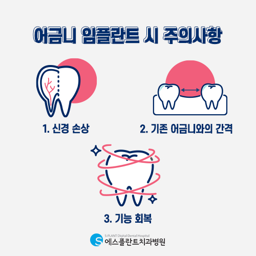 어금니 임플란트, 저작력을 높이는 것이 중요합니다. [에스플란트 치과병원] 관련 이미지 4