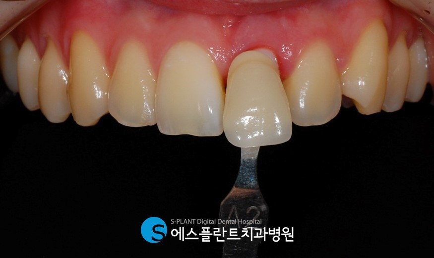 치아외상으로 인한 전치부 심미보철 임플란트는 강남 에스플란트 치과병원에서 관련 이미지 6