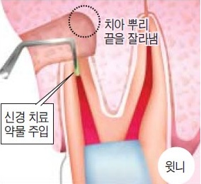 치아 썩으면 무조건 뽑고 임플란트? 최선입니까? 관련 이미지 5