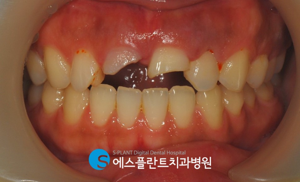 치아외상으로 인한 깨지고 부러진 치아, 강남 에스플란트치과병원에서 자연스럽게! 관련 이미지 2