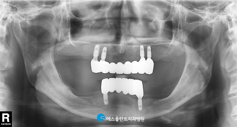임플란트와 틀니의 장점만 모은 임플란트틀니 관련 이미지 6