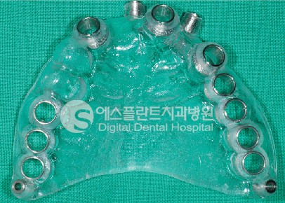 [뼈이식임플란트] 뼈이식 임플란트 후 주의사항, 자가치아 뼈이식 임플 란트 관련 이미지 4
