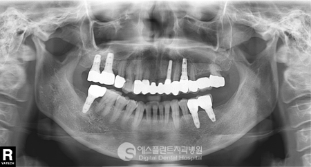 치아의 심미성은 사회성과도 연결됩니다 [에스플란트 치과병원] 관련 이미지 7