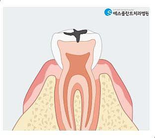 충치치료,내구성이뛰어난인레이로치아보존 관련 이미지 2