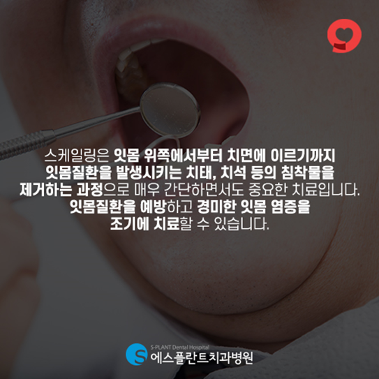 보험적용이 가능한 스케일링, 주기적인 스케일링으로 치아건강을 지키세요! 관련 이미지 2