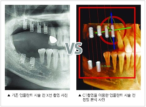 의식하진정요법을 이용한 임플란트+아나토마지 가이드 임플란트 관련 이미지 8