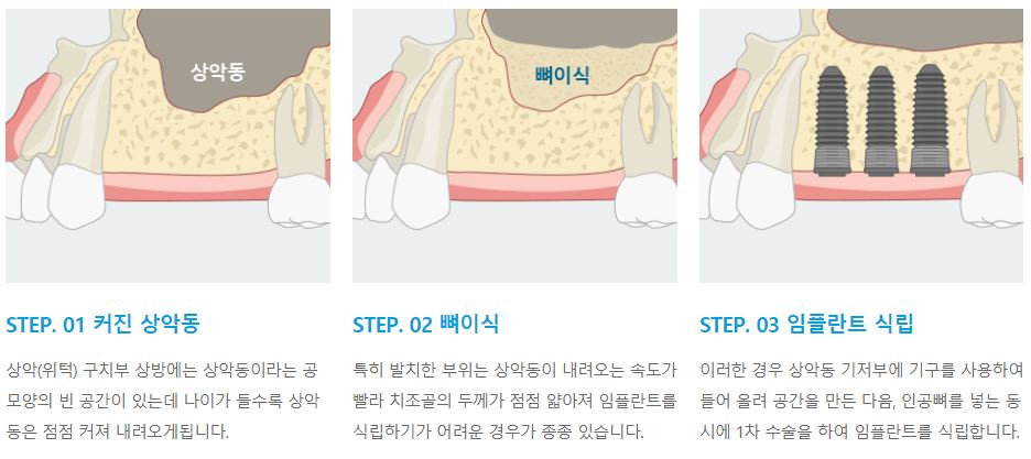 잇몸뼈가 부족하다면, 에스플란트 치과병원의 뼈이식 임플란트 관련 이미지 6