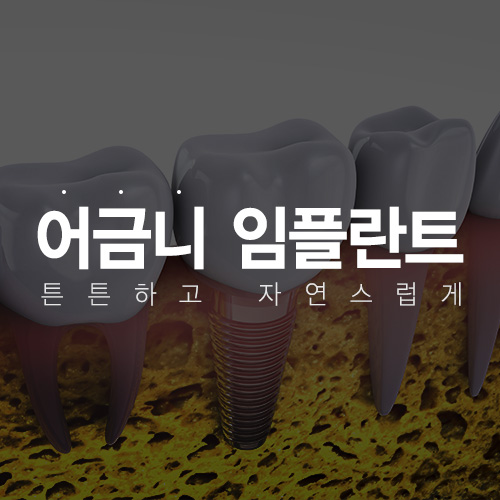 어금니 임플란트, 자연스럽고 튼튼하게 식립해야 합니다. [에스플란트 치과병원] 관련 이미지 3